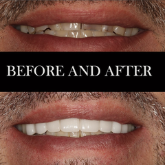 Our patient was embarrassed to smile which was affecting his life and relationships