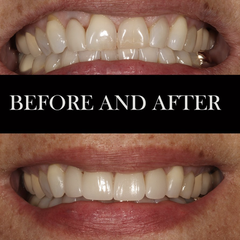 4 porcelain veneers to completely brighten her smile