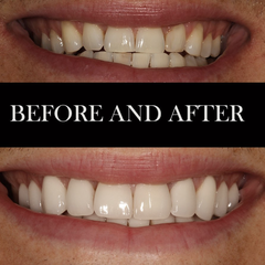 We used 20 beautiful porcelain veneers to enhance his smile