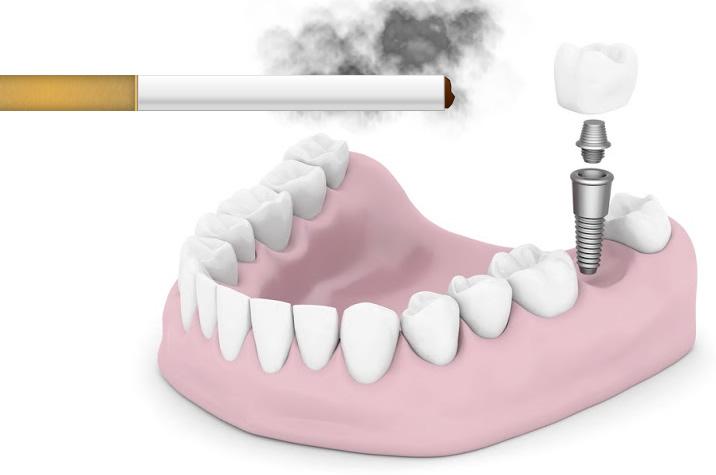 Huntington Beach Dental Implants