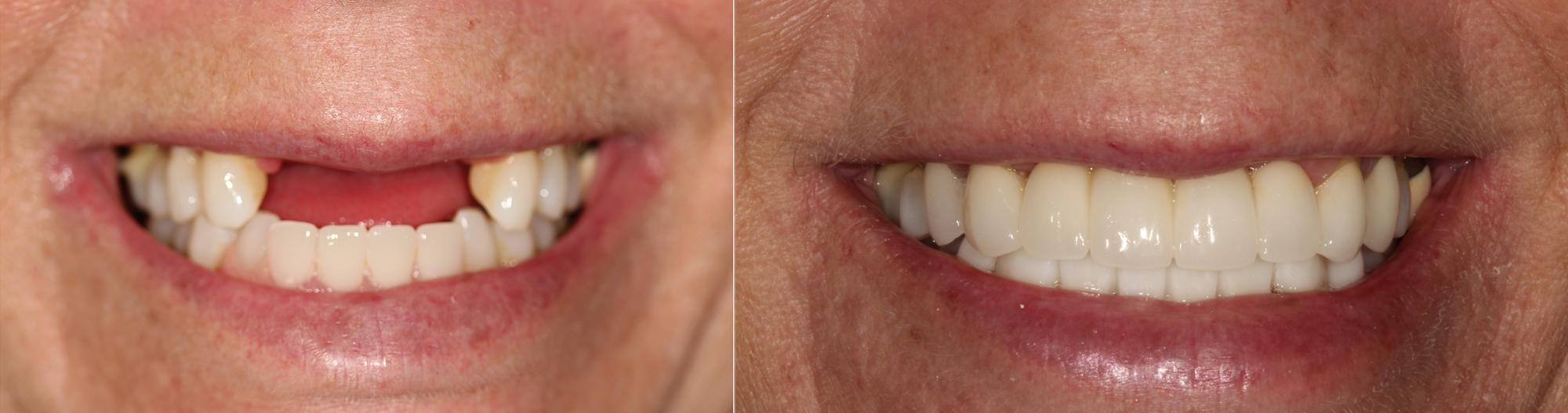Dental Cosmetic Bridge: Jason Cellars, DDS