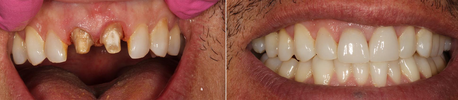 Dental Crowns in Huntington Beach