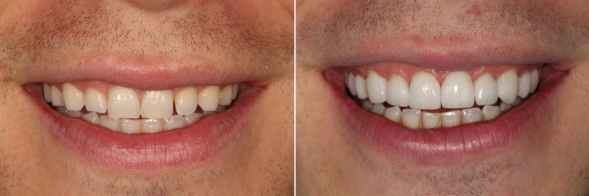 Huntington Beach Best Dentist: Veneers
