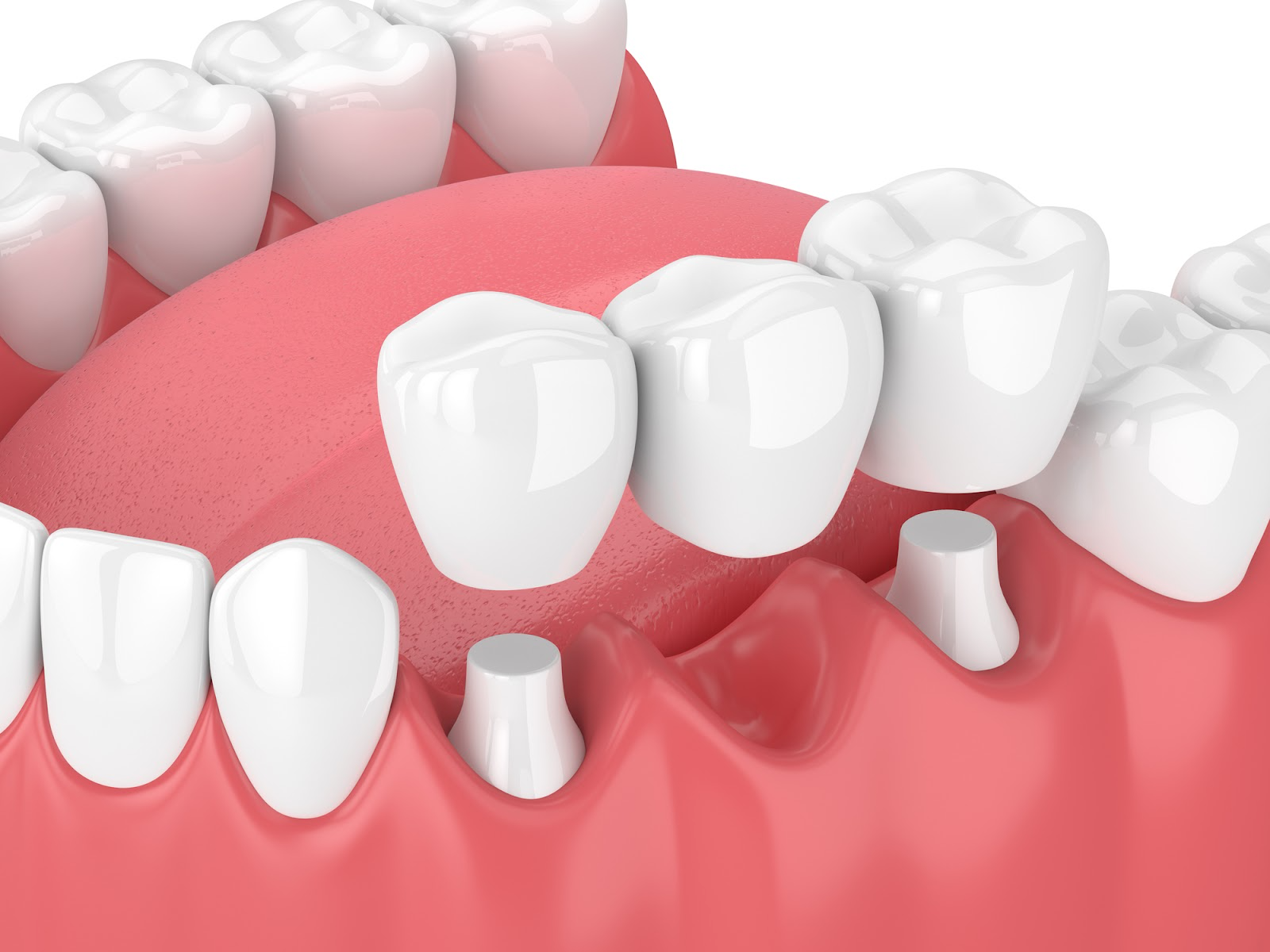 A three-dimensional rendering of a traditional dental bridge