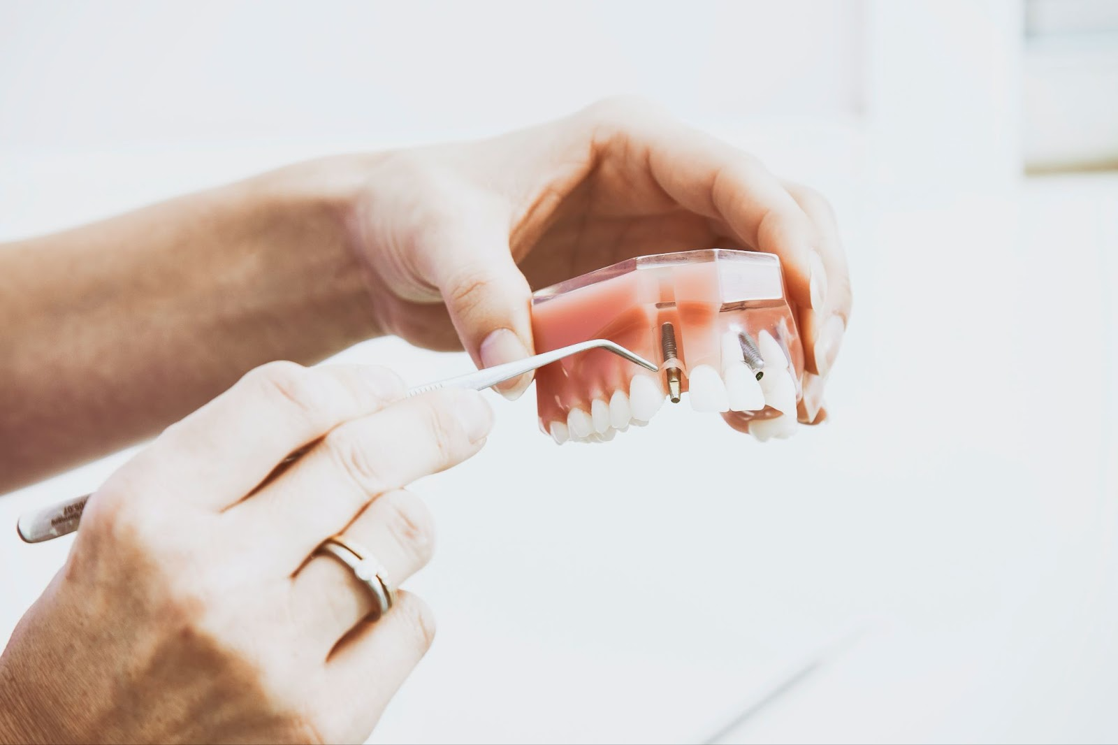 Dentist holds a model of a human maxilla, demonstrating how dental implants are embedded in the jawbone.