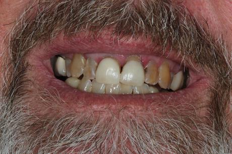 patient prior to treatment of dental veneers by Jason Cellars, DDS