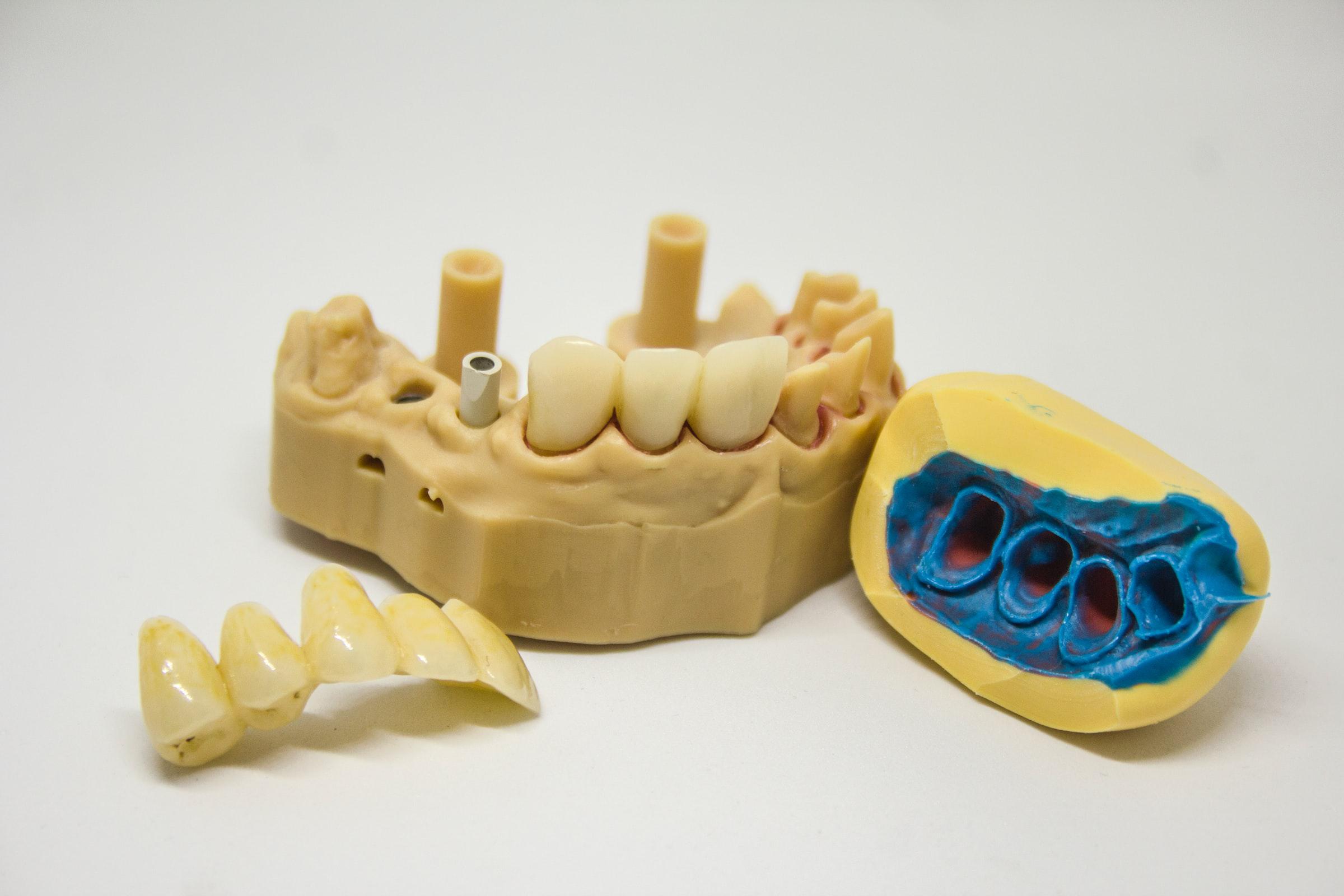 Invisalign tray and model: Jason Cellars in Huntington Beach