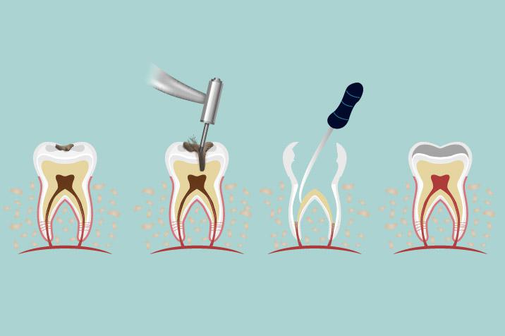 Root canal dentist in Huntington Beach, CA