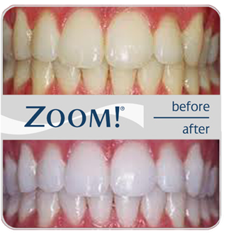 ZOOM teeth whitening in Huntington Beach